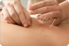 Akupunktur – auf den Punkt gebracht